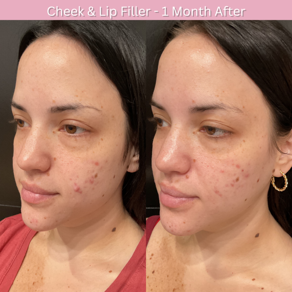 Dermal Fillers In Orlando Fl Soluma Aesthetics